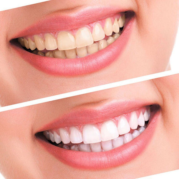 Teeth whitening 44% Peroxide Dental Bleaching System Gel Kit Bright Teeth Whitener Dental Equipment 10/6/4/3pc with Led lights