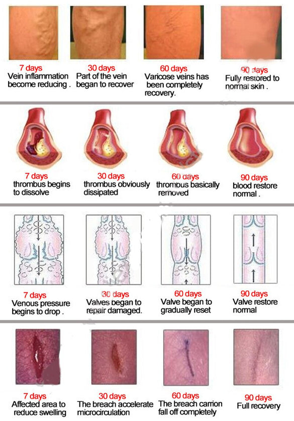 Varicose Veins Treatment  Cream Ointment Vasculitis Phlebitis Spider Veins Pain Varicosity Angiitis Remedy Removal Herbal Cream